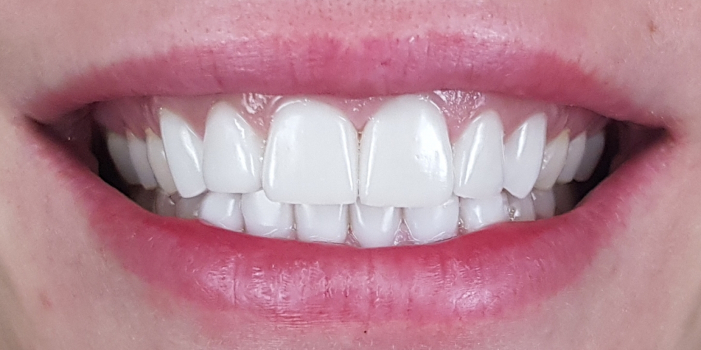 Цельнокерамические виниры E-max на передние зубы верхней и нижней челюсти, домашнее отбеливание - фото №2