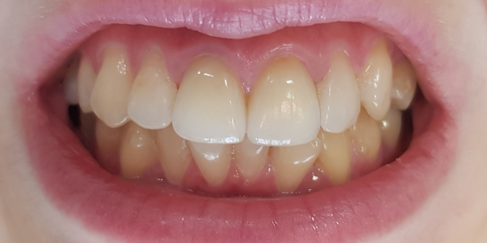 Цельнокерамические винир и коронка E-max на 11, 21 зуб - фото №2