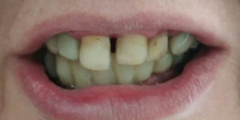 Дентальная имплантация на верхней и нижней челюсти с удалением всех зубов - фото №1