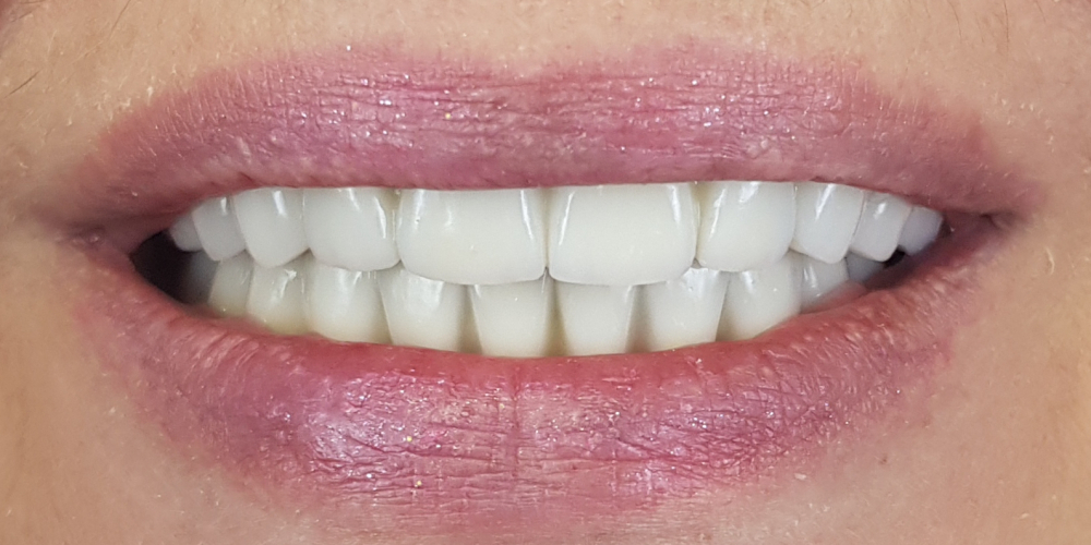Дентальная имплантация на верхней и нижней челюсти с удалением всех зубов - фото №2