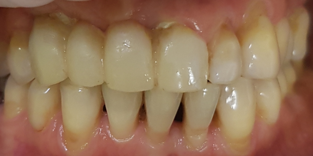 Дентальная имплантация с удалением зубов в переднем отделе на верхней челюсти - фото №1