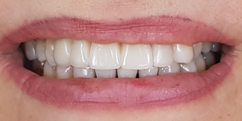 Дентальная имплантация с удалением зубов в переднем отделе на верхней челюсти - фото №2