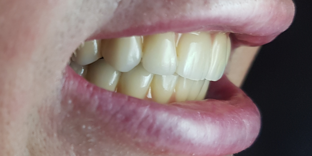 Дентальная имплантация на верхней и нижней челюсти с удалением всех зубов по показаниям - фото №2