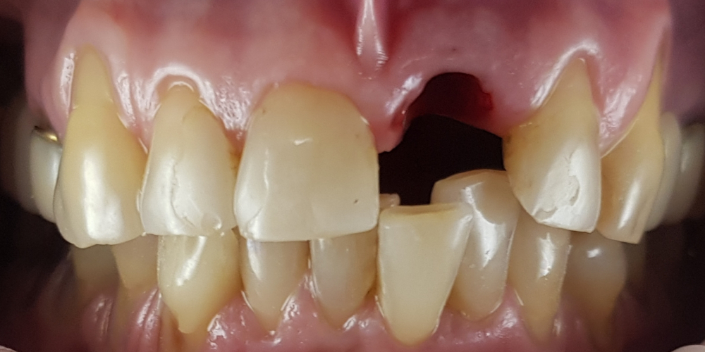 Дентальная имплантация 1 зуба на верхней челюсти, цельнокерамическая коронка с опорой на имплантат - фото №1