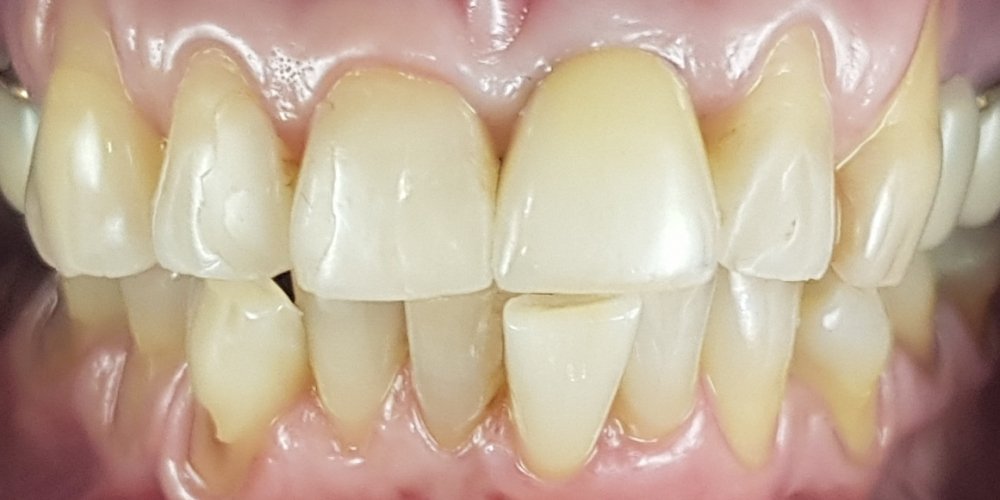 Дентальная имплантация 1 зуба на верхней челюсти, цельнокерамическая коронка с опорой на имплантат - фото №2