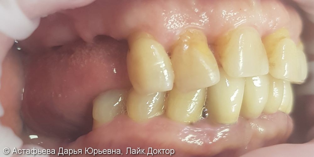 Протезирование жевательных зубов с опорой на имплантатах, до и после - фото №1