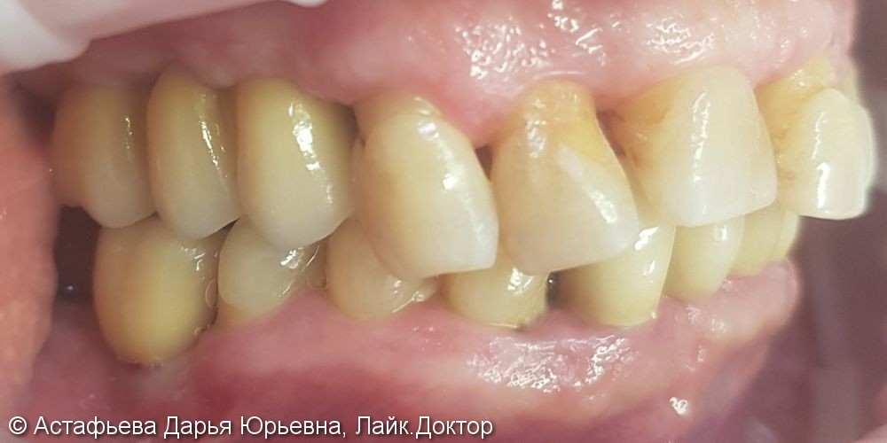 Протезирование жевательных зубов с опорой на имплантатах, до и после - фото №2