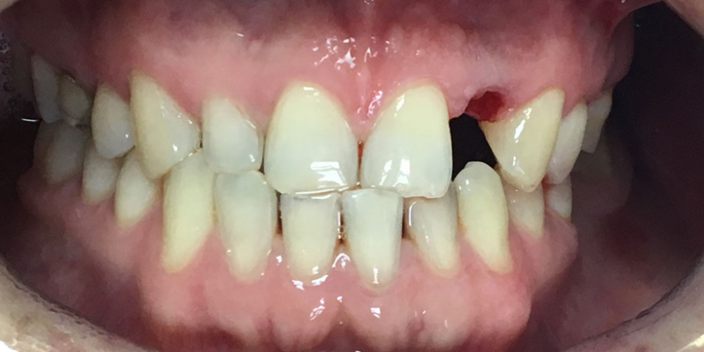 Одномоментная имплантация Osstem переднего зуба - фото №1