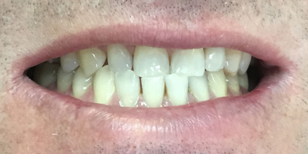 Одномоментная имплантация Osstem переднего зуба - фото №2