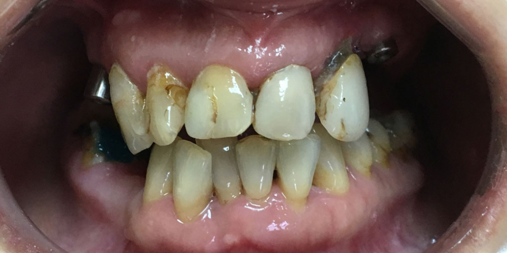 Комплексное восстановление зубов верхней и нижней челюсти - фото №1