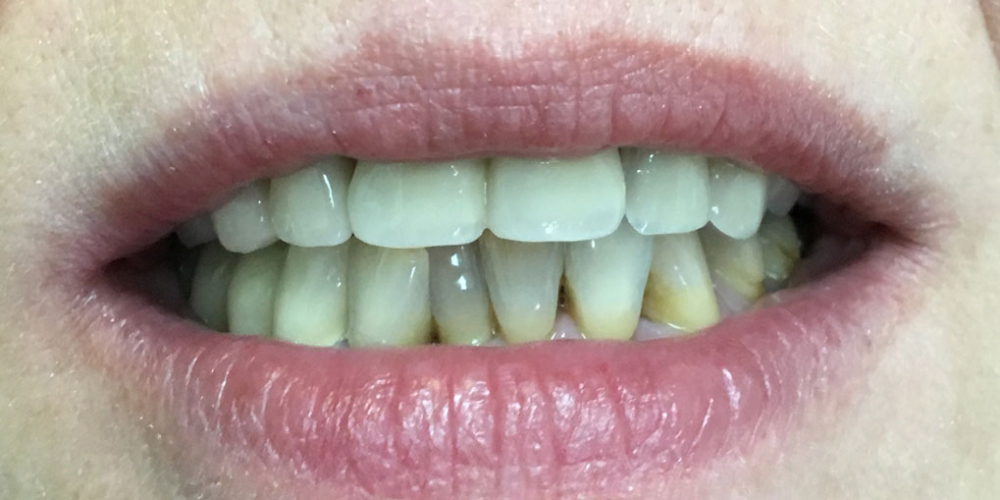 Комплексное восстановление зубов верхней и нижней челюсти - фото №2