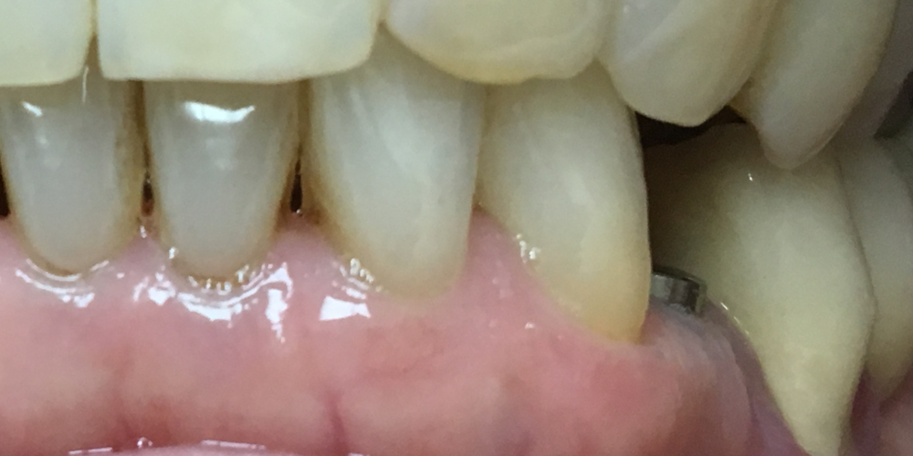 Восстановление отсутствующего зуба имплантатом - фото №1