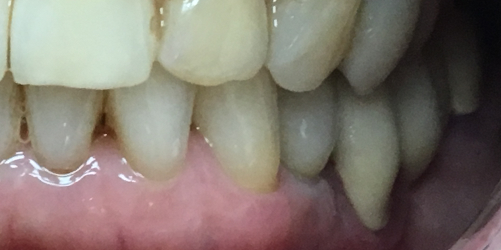 Восстановление отсутствующего зуба имплантатом - фото №2