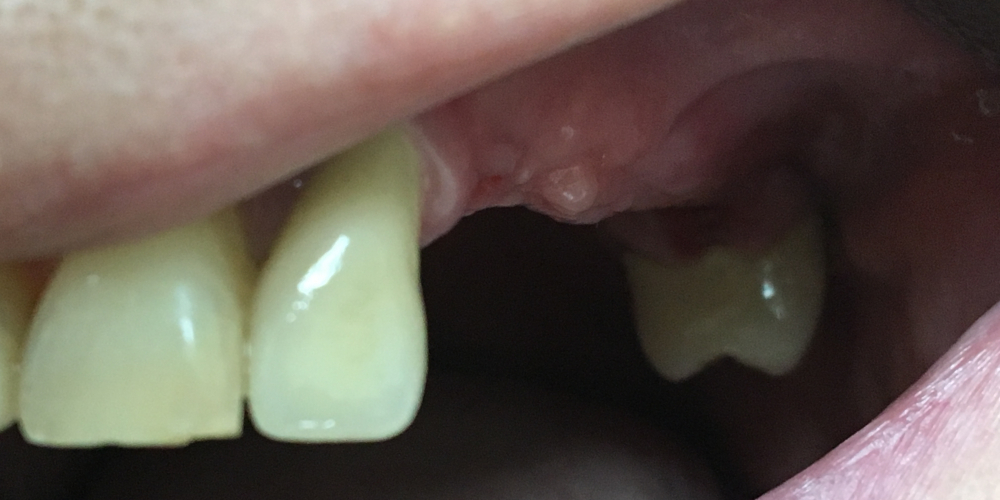 Протезирования боковой группы зубов на верхней челюсти слева на имплантатах - фото №1