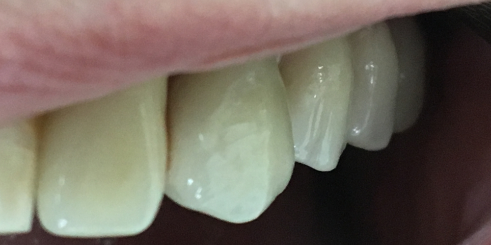 Протезирования боковой группы зубов на верхней челюсти слева на имплантатах - фото №2