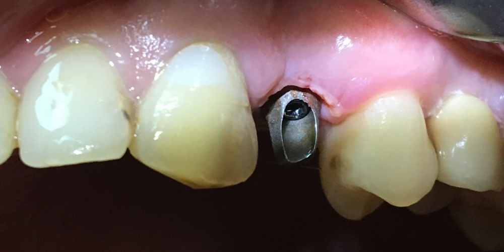 Имплантация с одномоментным удалением корня зуба - фото №1