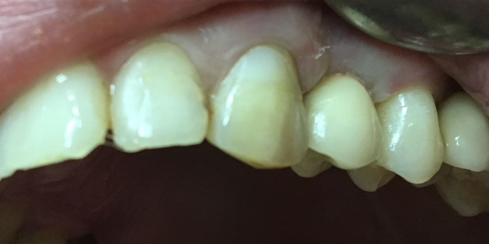 Имплантация с одномоментным удалением корня зуба - фото №2