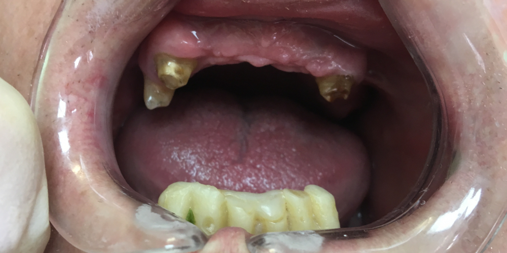 Комплексное восстановление жевательной функции при частичном отстутствии зубов - фото №1