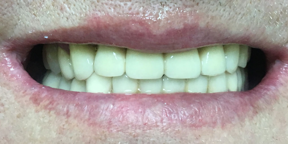 Комплексное восстановление жевательной функции при частичном отстутствии зубов - фото №2
