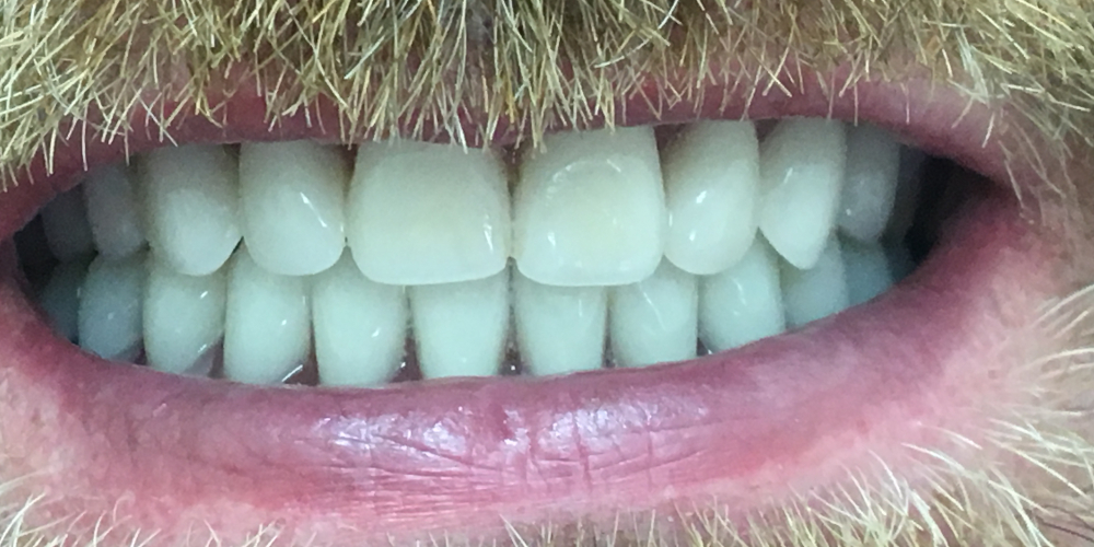 Жалобы на полное отсутствие зубов на верхней и нижней челюсти - фото №2