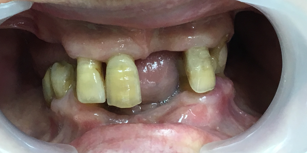 Протезирование с применением имплантатов и сохранением своих зубов - фото №1