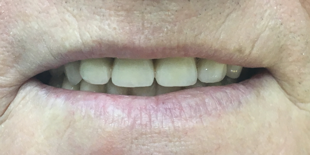 Протезирование с применением имплантатов и сохранением своих зубов - фото №2