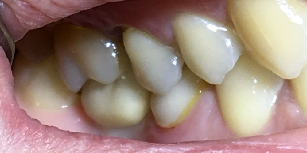 Восстановить жевательную функцию после утраты зуба более года назад - фото №2