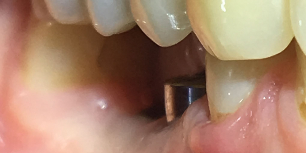 Восстановить жевательную функцию вследствие утраты двух зубов - фото №1