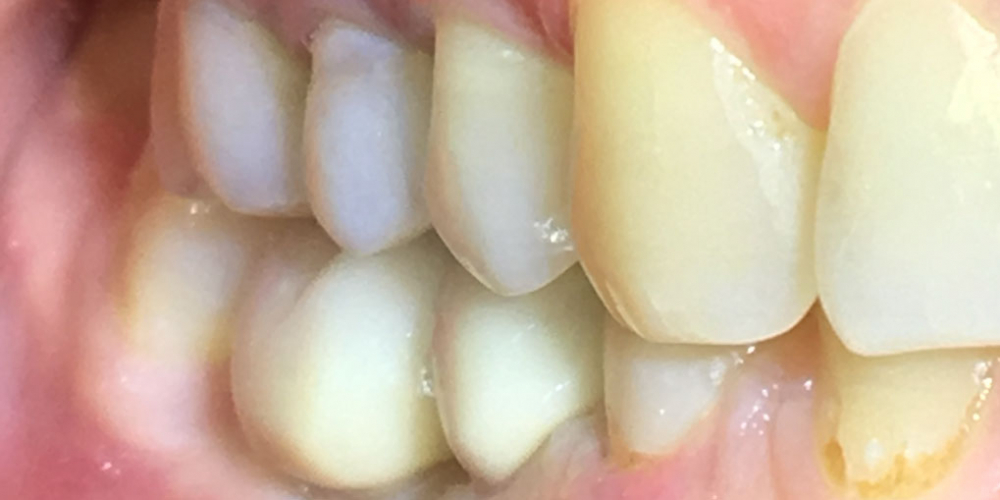 Восстановить жевательную функцию вследствие утраты двух зубов - фото №2