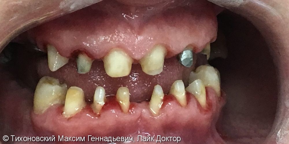 Тотальное протезирование зубов с помощью  цельнокерамических коронок и имплантов - фото №1
