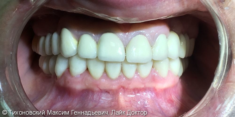 Тотальное протезирование зубов с помощью  цельнокерамических коронок и имплантов - фото №2