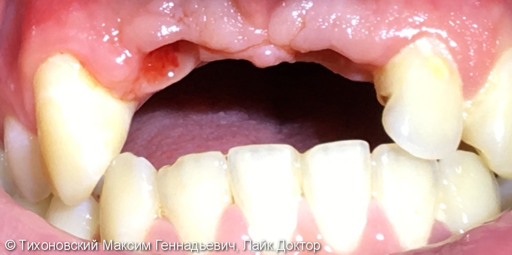 Имплантация в области отсутствующих 11, 21 зубов - фото №1