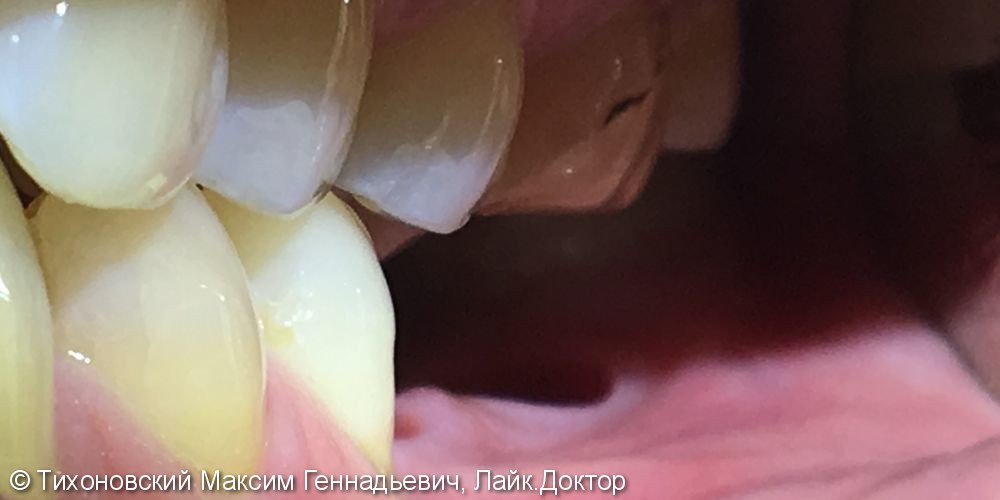 Установка имплантов в области ранее утраченных жевательных зубов нижней челюсти слева - фото №1