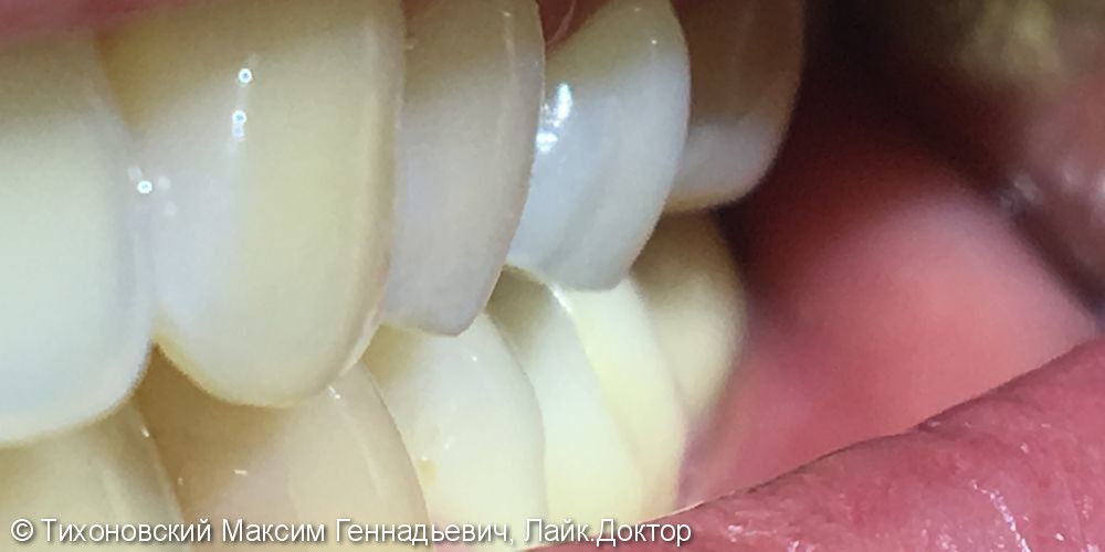 Установка имплантов в области ранее утраченных жевательных зубов нижней челюсти слева - фото №2