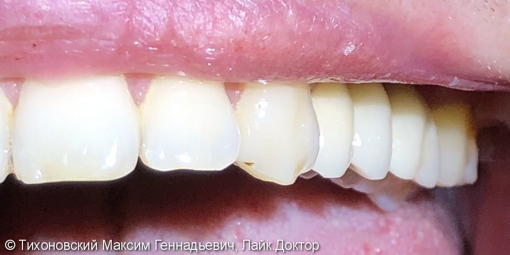 Установка дентальных имплантов в область утраченных 24, 25 зубов - фото №2