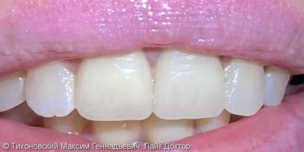 Установка коронок из материала IPS e.max press на зубы 11-21 - фото №2