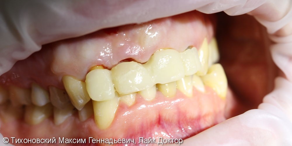 Циркониевый коронки на фронтальные зубы и имплантат - фото №1
