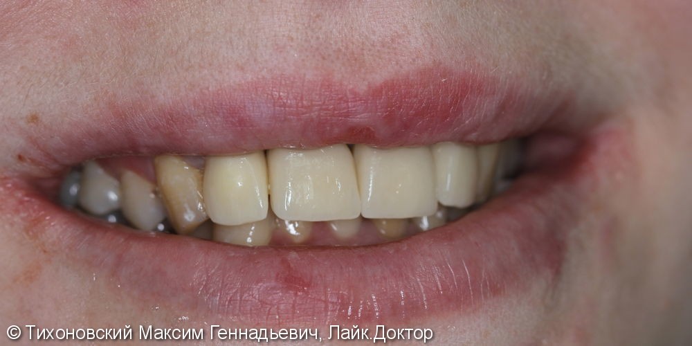 Циркониевый коронки на фронтальные зубы и имплантат - фото №2