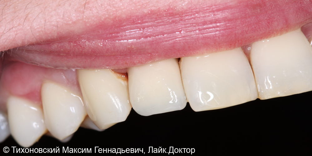 замещение утраченного зуба имплантатом - фото №1