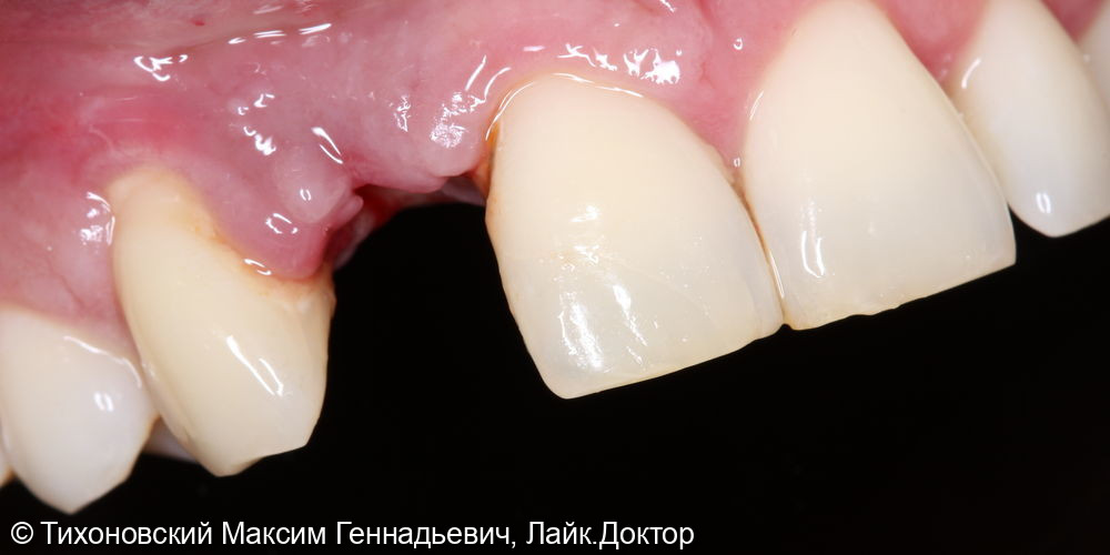 замещение утраченного зуба имплантатом - фото №2