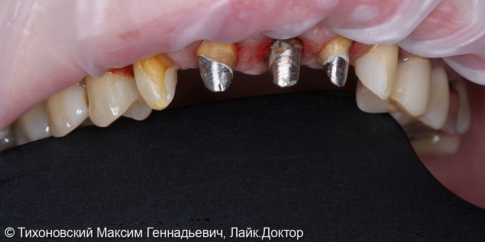 Замещение зубов 12-23 одиночными коронками из диоксида циркония - фото №1