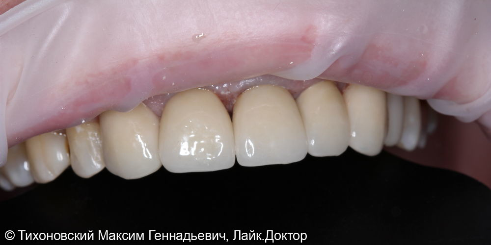 Замещение зубов 12-23 одиночными коронками из диоксида циркония - фото №2