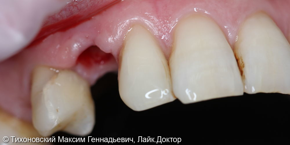 Замещение 13 зуба с глубоким деффектом имплантатом Osstem (одномоментная имплантация) - фото №1