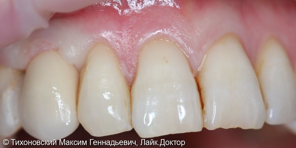 Замещение 13 зуба с глубоким деффектом имплантатом Osstem (одномоментная имплантация) - фото №2
