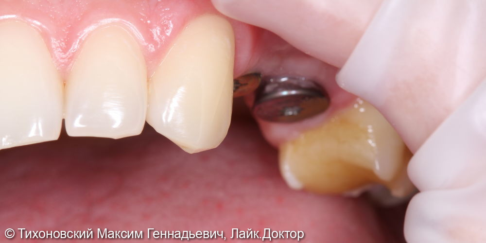 Восстановление утраченных зубов имплантатами Straumann с циркониевыми коронками - фото №1