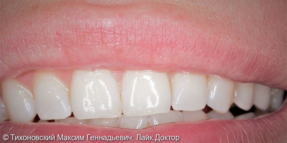 Восстановление утраченных зубов имплантатами Straumann с циркониевыми коронками - фото №2