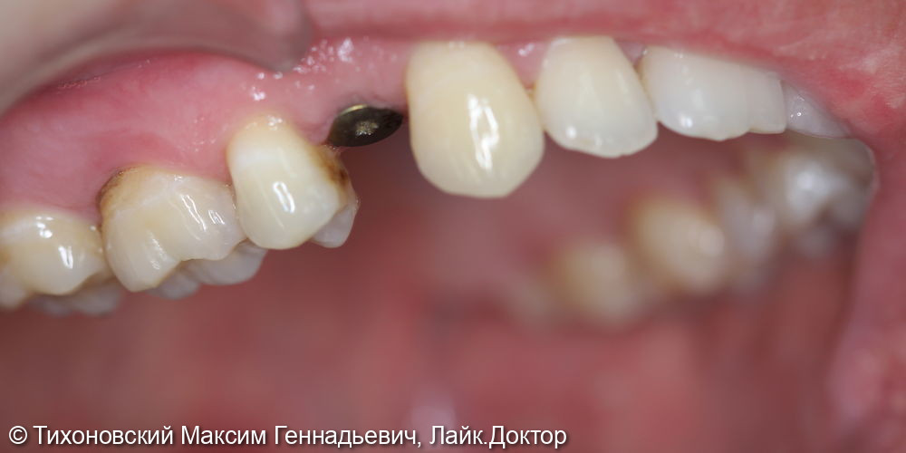 Имплантация ранее утраченного 14 зуба имплантатом Straumann и коронкой из диоксида циркония - фото №1