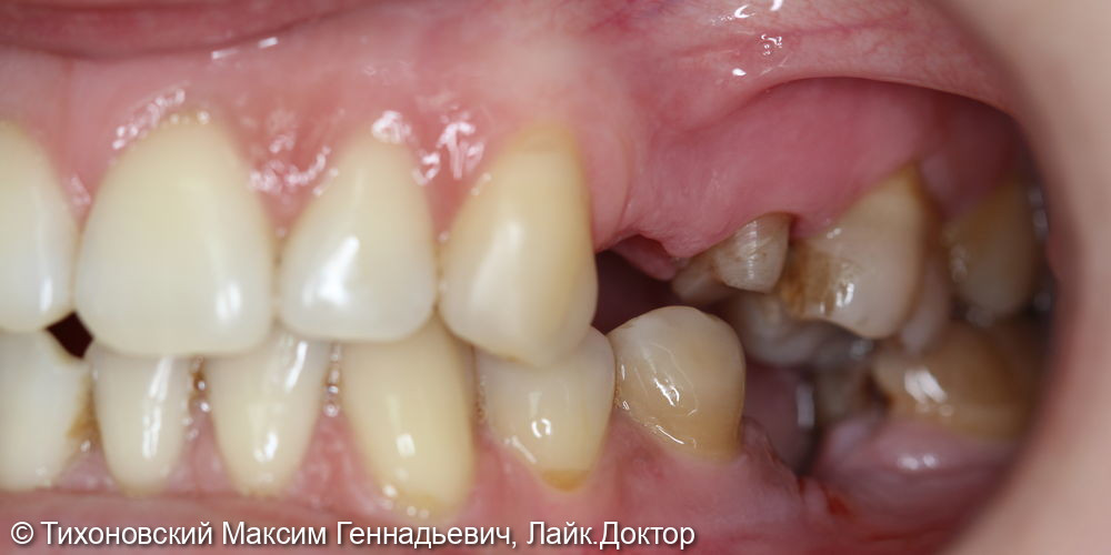 Установка имплантата с покрытием его циркониевой коронкой и коронки из - фото №1