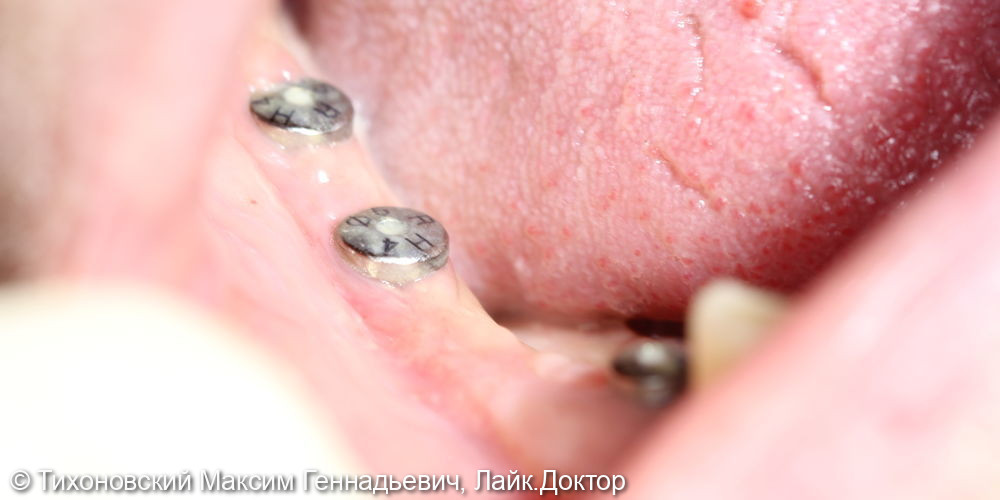 Имплантация зубов и протезирование коронками из диоксида циркония - фото №1