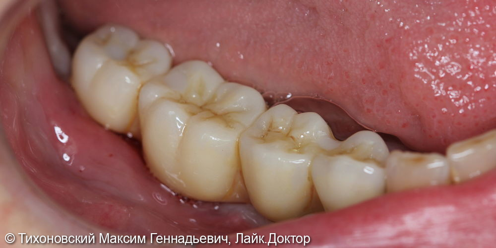 Имплантация зубов и протезирование коронками из диоксида циркония - фото №2